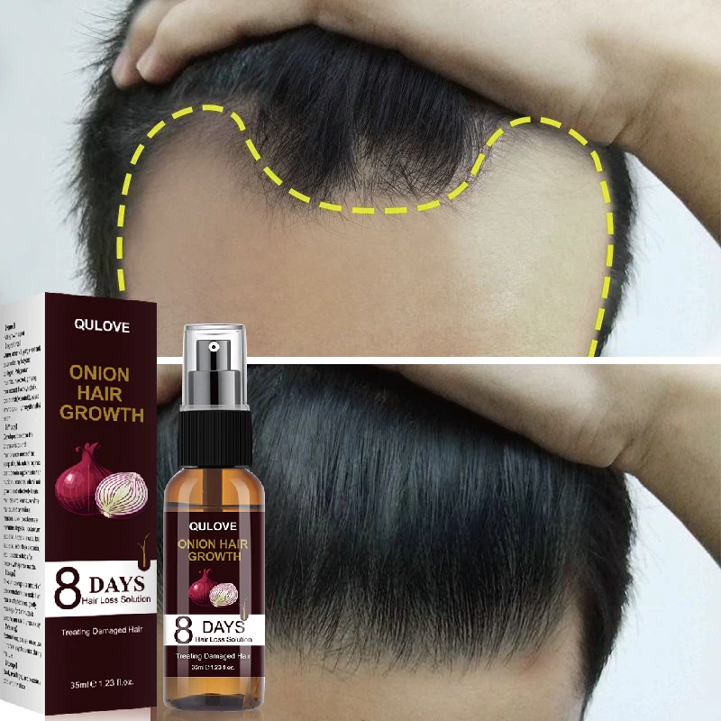 

Powerful Hair Growth Serum Onion Spray Anti Hairs Loss Products Treatment Essence Repair Nourish Roots Regrowth For Men Women