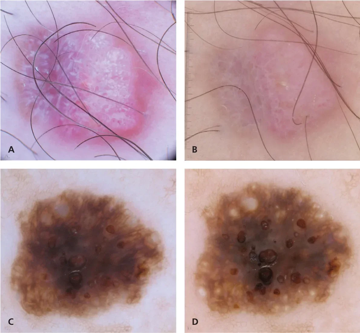 Универсальный дерматоскоп IBOOLO DE-400 с 10-кратным увеличением мобильным дермоскопом