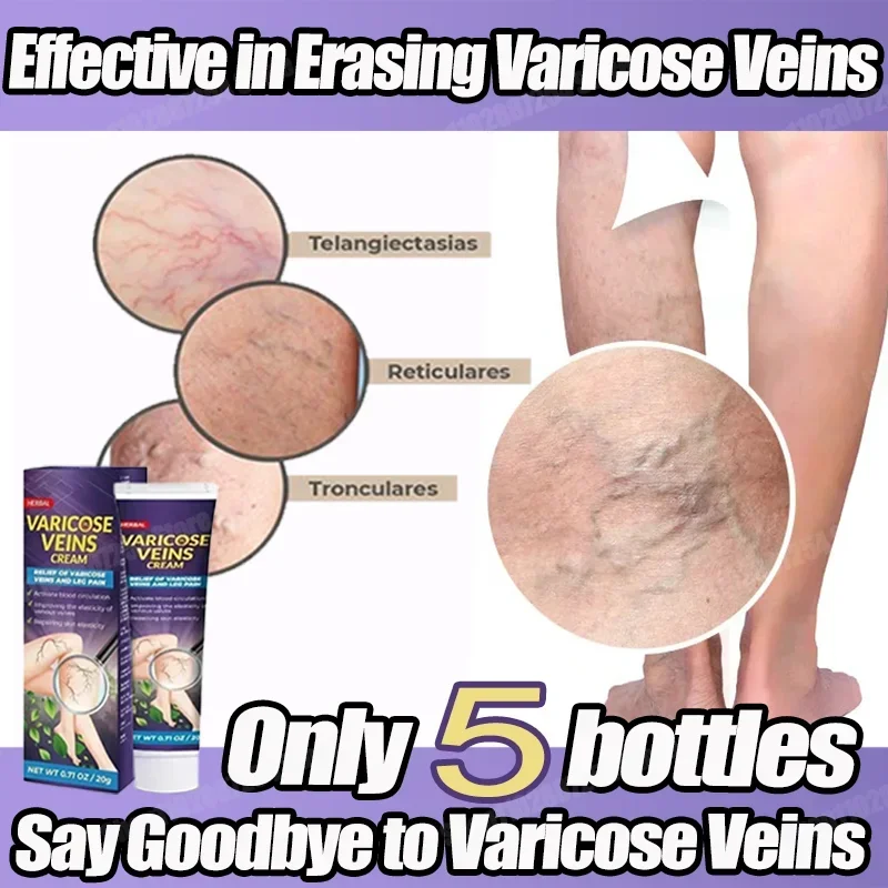 Мазь от варикозного расширения вен устраняет васкулит флебит чтобы облегчить