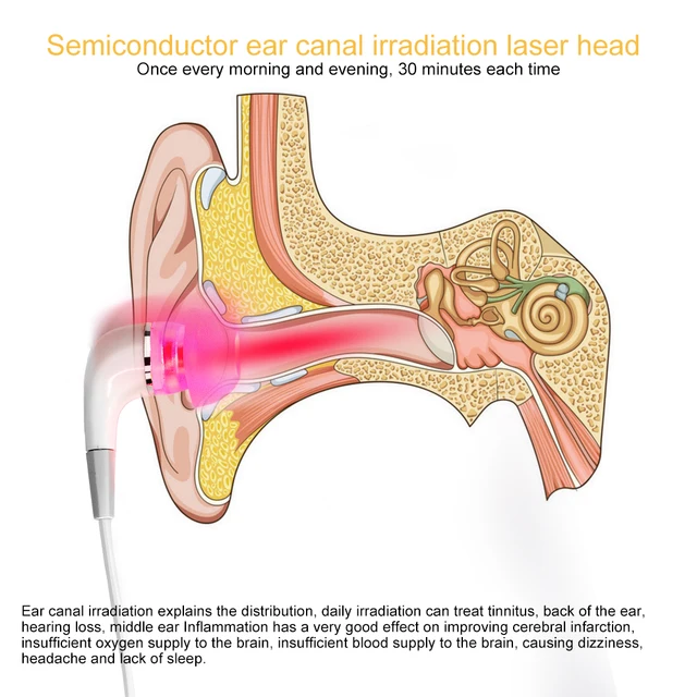 Tinnitus Ear Laser Therapy LLLT Irradiation Laser Physiotherapy Earplug Otitis Media Deafness Diabetes Hypertension Treatment 3