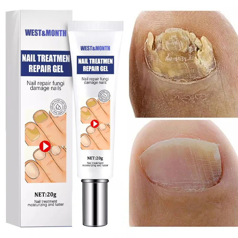 

Fungal Nail Repair Serum Treatment Nail Fungus Removal Paronychia Onychomycosis Foot Care Toe Fungus Anti-infective Gel Products