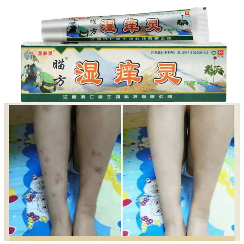 

Psoriasis Dermatitis Eczematoid Eczema Ointment Treatment for Children Adult China's Secret Recipe 15g