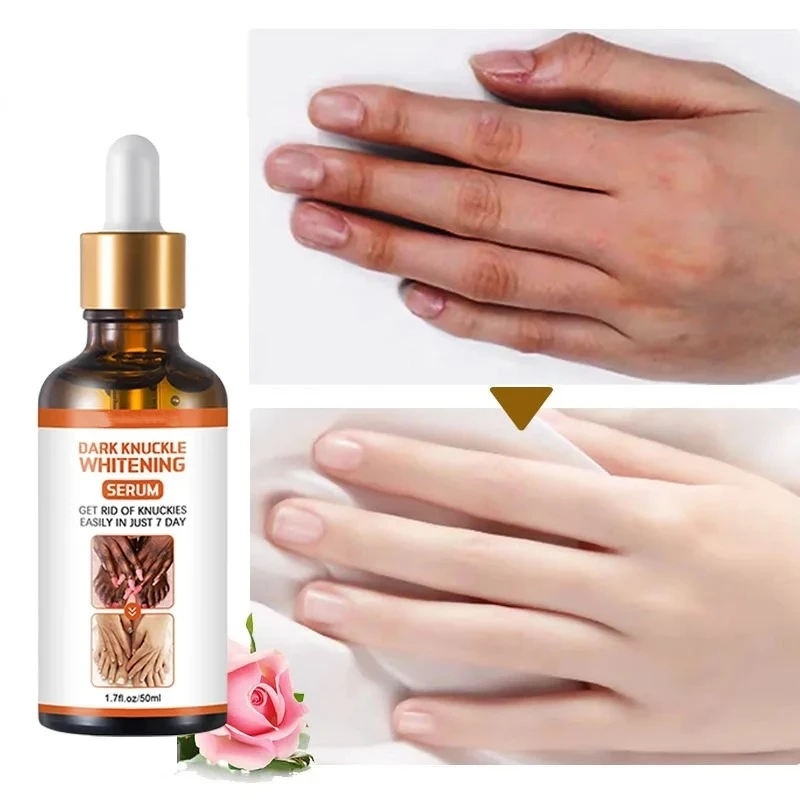 Отбеливающая сыворотка осветляет суставы пальцы локти колени улучшает кожу тела