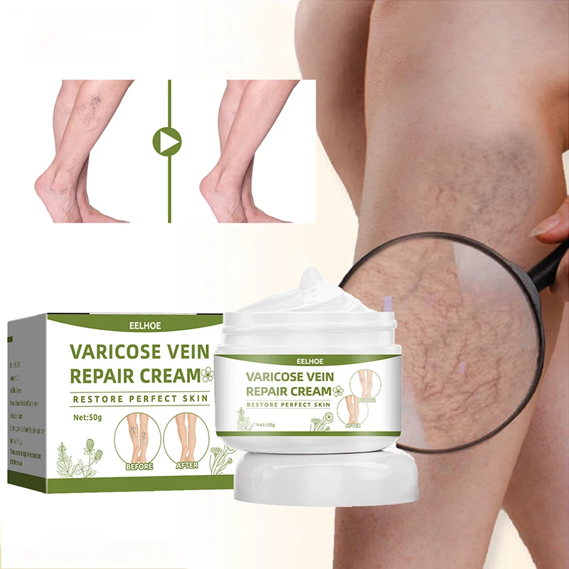 

Varicose Vein Repair Cream Natural Herbal Vasculitis Phlebitis Spider Pain Relief Ointment Varicose Vein Treatment Health Care