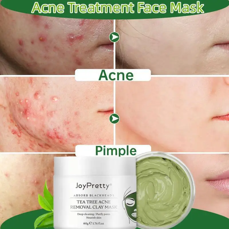 

Herbal Acne Remove Mask Natural Repair Pimple Eliminate Acne Scar Shrink Pore Deep Cleaning Oil Control Moisture Face Skin Care