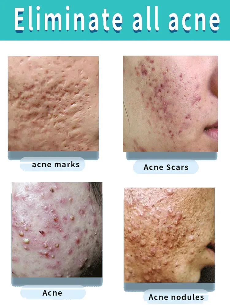 Салициловая кислота крем для лечения прыщей гель восстановления против