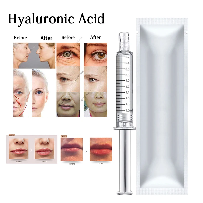 

2ml Hyaluronic Acid Serum Lip/Nose/Cheek Hyaluronic Acid Crosslinked HA Lips Enhancement for Hyaluron Pen Remove Wrinkles Kroea