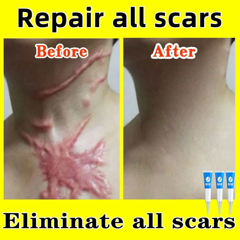 

Scar repair gel fades scars burns burns cesarean section stretch marks acne pits acne marks surgical scars