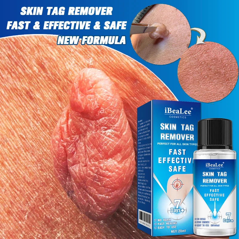 

iBeaLee Skin Tag Remover Serum Painless 7Days Removal Dark Spot Mole Warts Freckle Face Flat Wart Cream Treatment Essential Oil