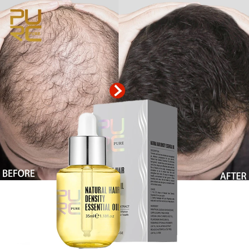 

Natural Ginger Hair Growth Essence Fast Regrowth Oil Thickener Regrowth Serum Treatments Oil Treatment Hair Loss Scalp Hair Care