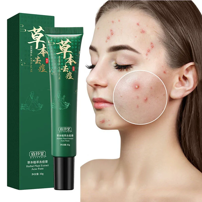 30ml Chinese Acne Cream Anti-Acne Removal Cream Face Back Pimples Scar Dark Spots Oil Control Whitening Moisturizing Anti-Aging