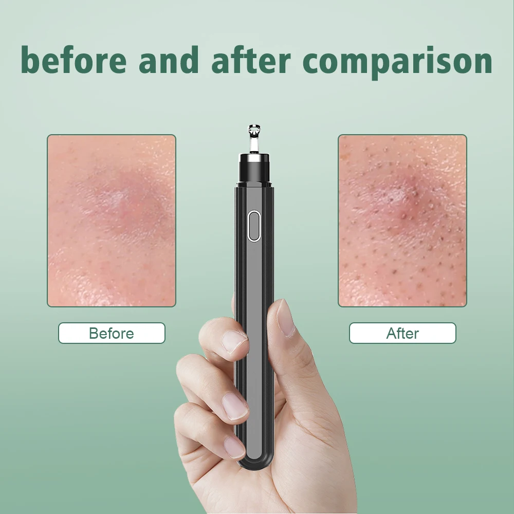 Умный визуальный аппарат для удаления черных точек средство игла косметическое
