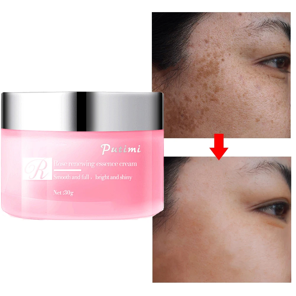 

Whitening Freckle Cream Remove Dark Spots Melanin Melasma Brighten Face Cream Pigmentation Anti-Aging Skin Care Cosmetics 30ML