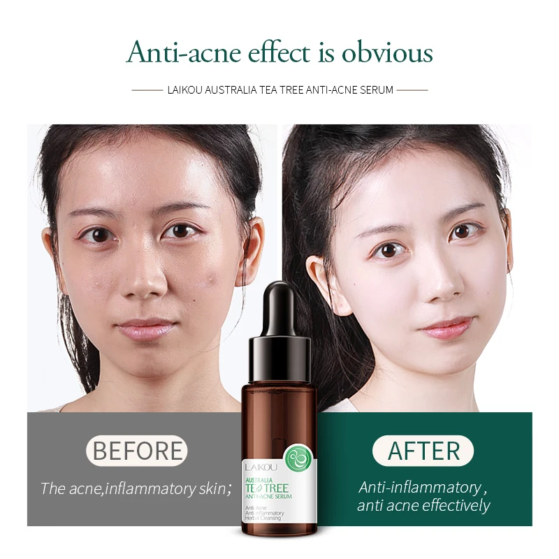 

Tea Tree Acne Face Serum Remove Pimples Fade Acne Marks Shrink Pores Essence Oil Control Moisturizing Whitening Facial Skin Care