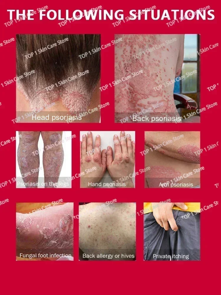 Натуральный растительный экстракт для удаления псориаза от дерматита