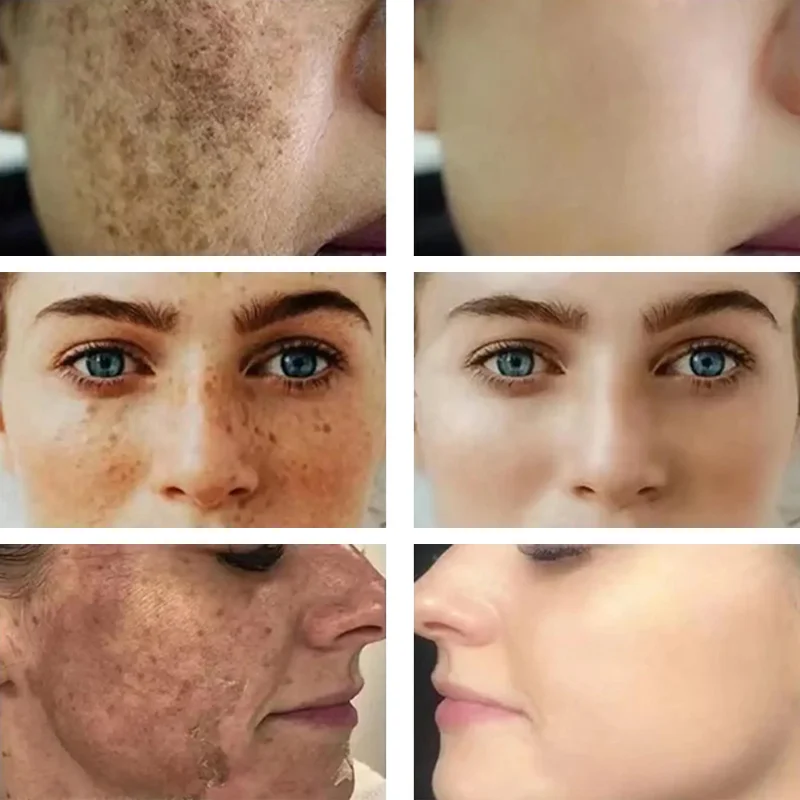 Отбеливающая Сыворотка для лица Dark средство удаления пятен коррекция веснушек