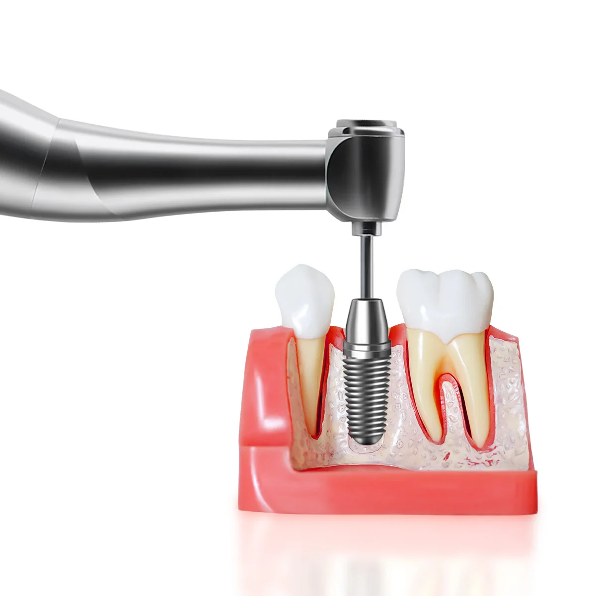 Беспроводной набор инструментов для имплантации зубов и 16 типов