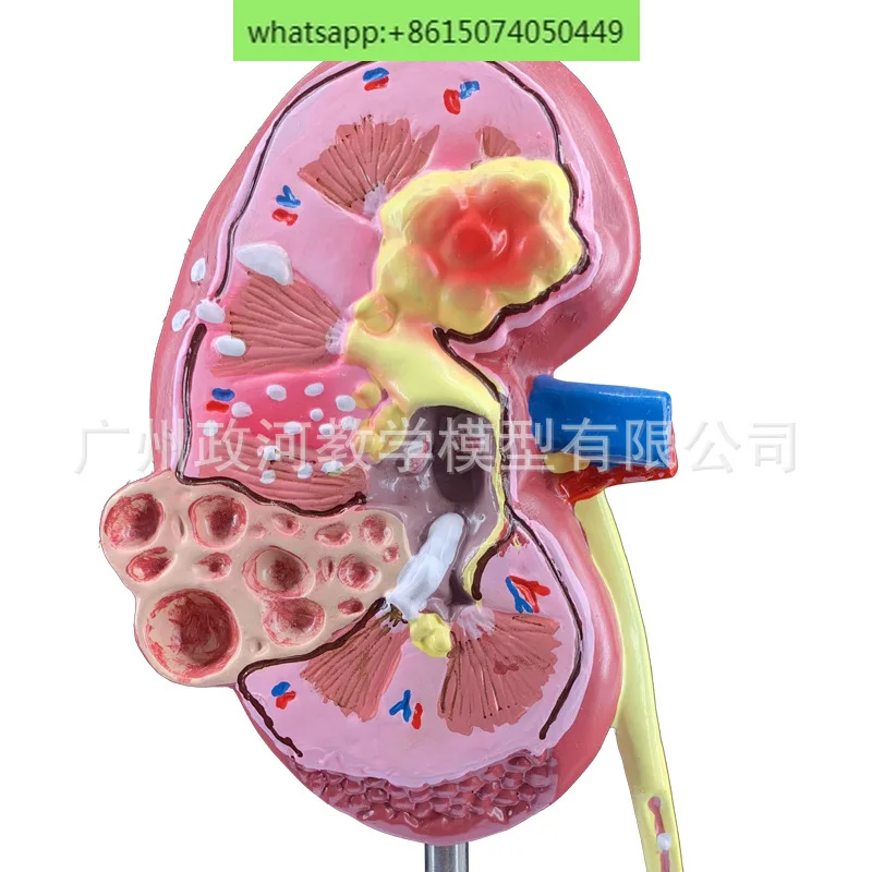 Моделирование обучения модель патологической почки образец почечной анатомии