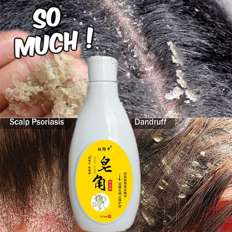 

210ml（7.1fl oz) Saponin Therapeutic Shampoo Anti-Dandruff Treatment Itching and Flaking Scalp Psoriasis Seborrheic Dermatitis