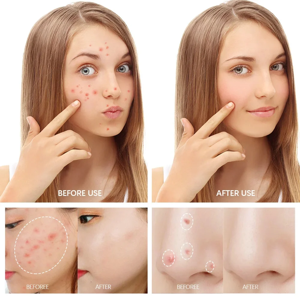 Рисунок 2 - Эффективное средство для лечения акне