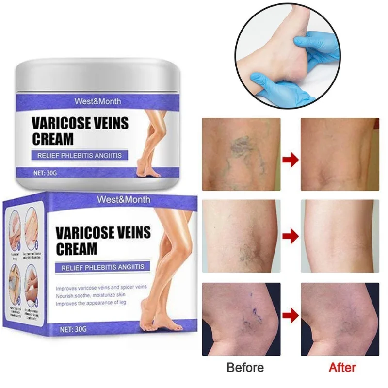 

Effective Varicose Veins Treatment Relief Cream Relieve Vasculitis Phlebitis Spider Pain Ointment Medical Plaster Body Care 30g