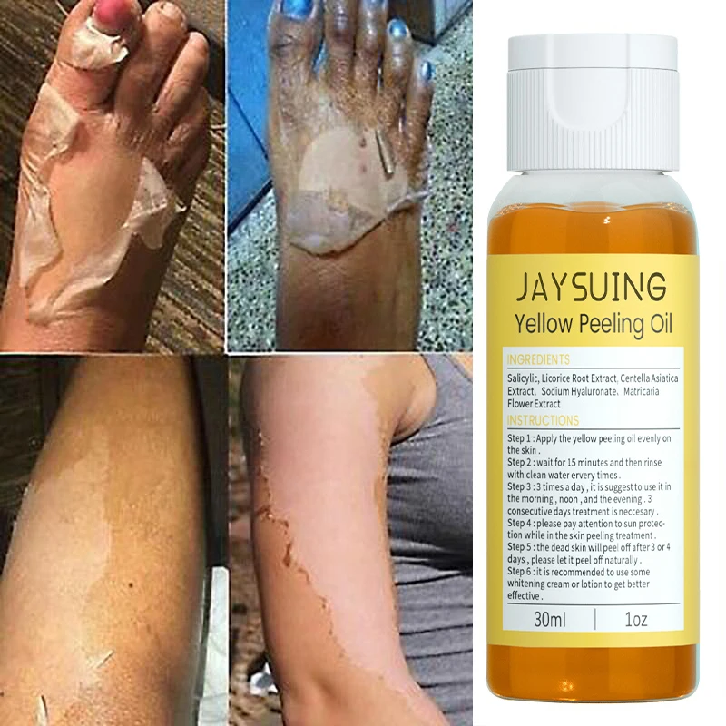 

Body Exfoliation Yellow Peeling Oil Bleaching Dark Skin Remove Arm Knee Legs Melanin Brightening Whitening Beauty Skin Care 30ml