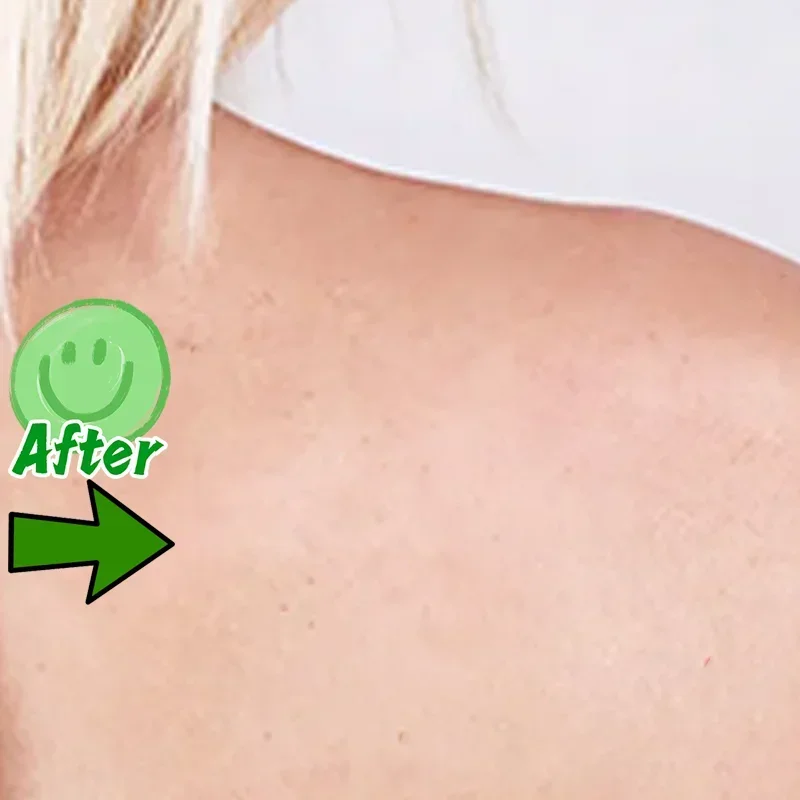 Морской невус на голове бородавки кожу головы обезьяне каулифтовая ручка