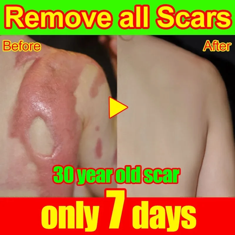 

Scar Removal Cream Effective Repair Surgical Scars Stretch Marks Acne Pits Pockmarks Burn Scars Repair Severe Scars