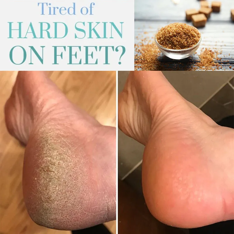 

Brown Sugar Goat Milk Exfoliating Gel Foot Exfoliator Remove Dead Skin Eliminate Cracked Heels Get Smooth Soft Baby Feet Peeling