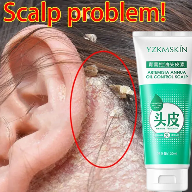 

130ml Scalp Cleansing Shampoo Oil Control Psoriasis Removal Acne Dandruff Seborrheic Follicles Antibacterial Anti-itching Mites