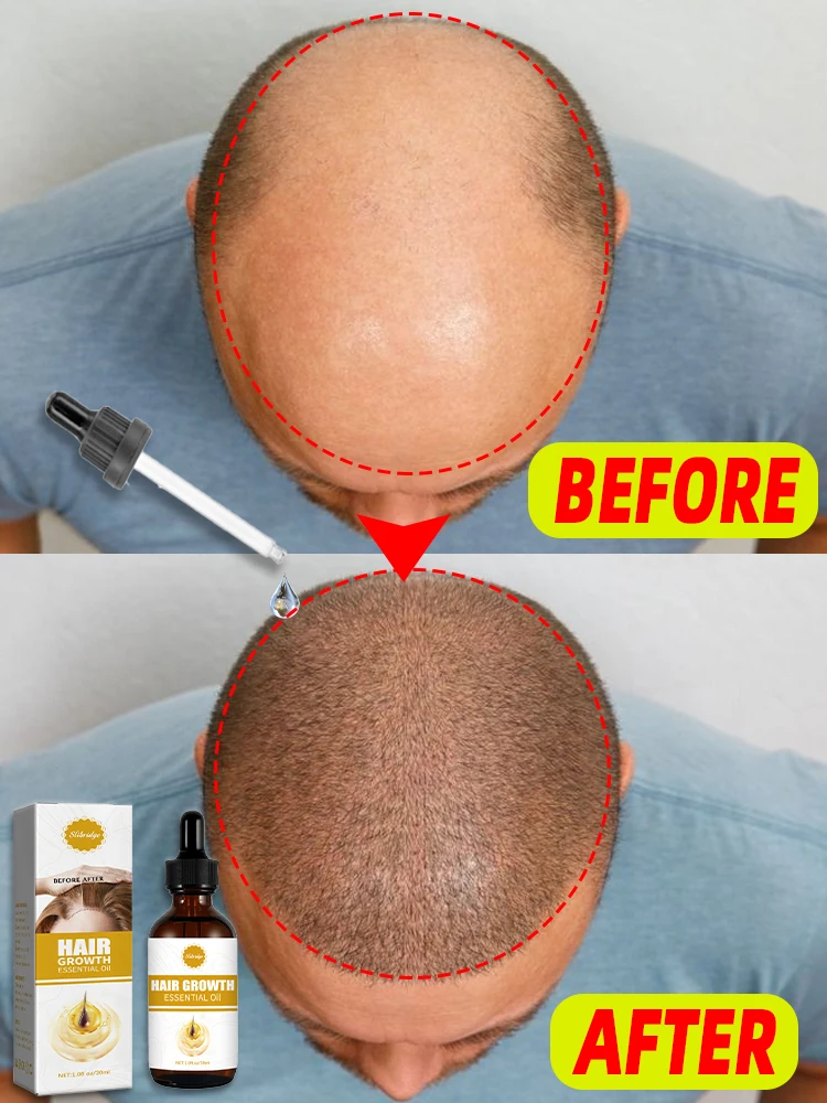 Sólo se necesitan 7 días para reparar la calvicie. El aceite esencial el crecimiento del cabello puede eficazmente