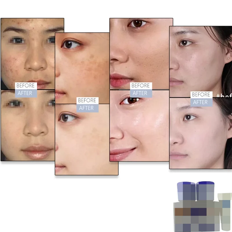7 DAYS WORK Freckles Removal Day&Night Cream Set Anti-Allergy Cream Skin Whitening Face Cream Remove Dark Spots Pigment