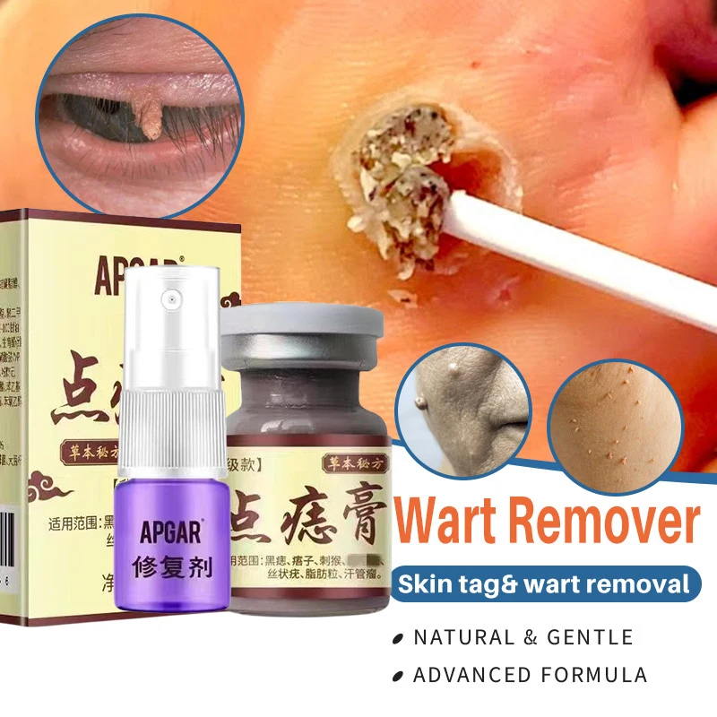 

Warts Remover Cream Effective Treatment Skin Tag Flat Wart Foot Corn Ointment Remove Face Dark Spot 100% Herbal Extract SkinCare