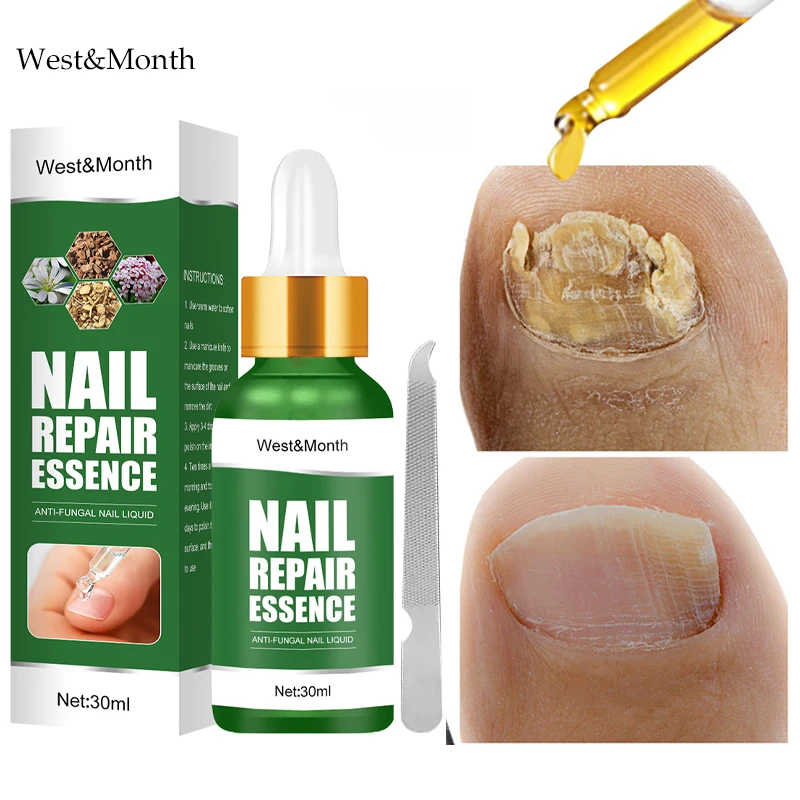 

Nail Fungus Treatment Serum Cuticle Oil Foot Anti-Fungal Nails Repair Infection Essence Onychomycosis Paronychia Nourishing Care