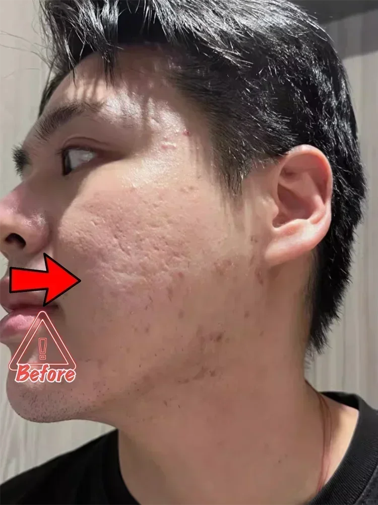 Мужской крем для восстановления отверстий против прыщей устраняющий отверстие