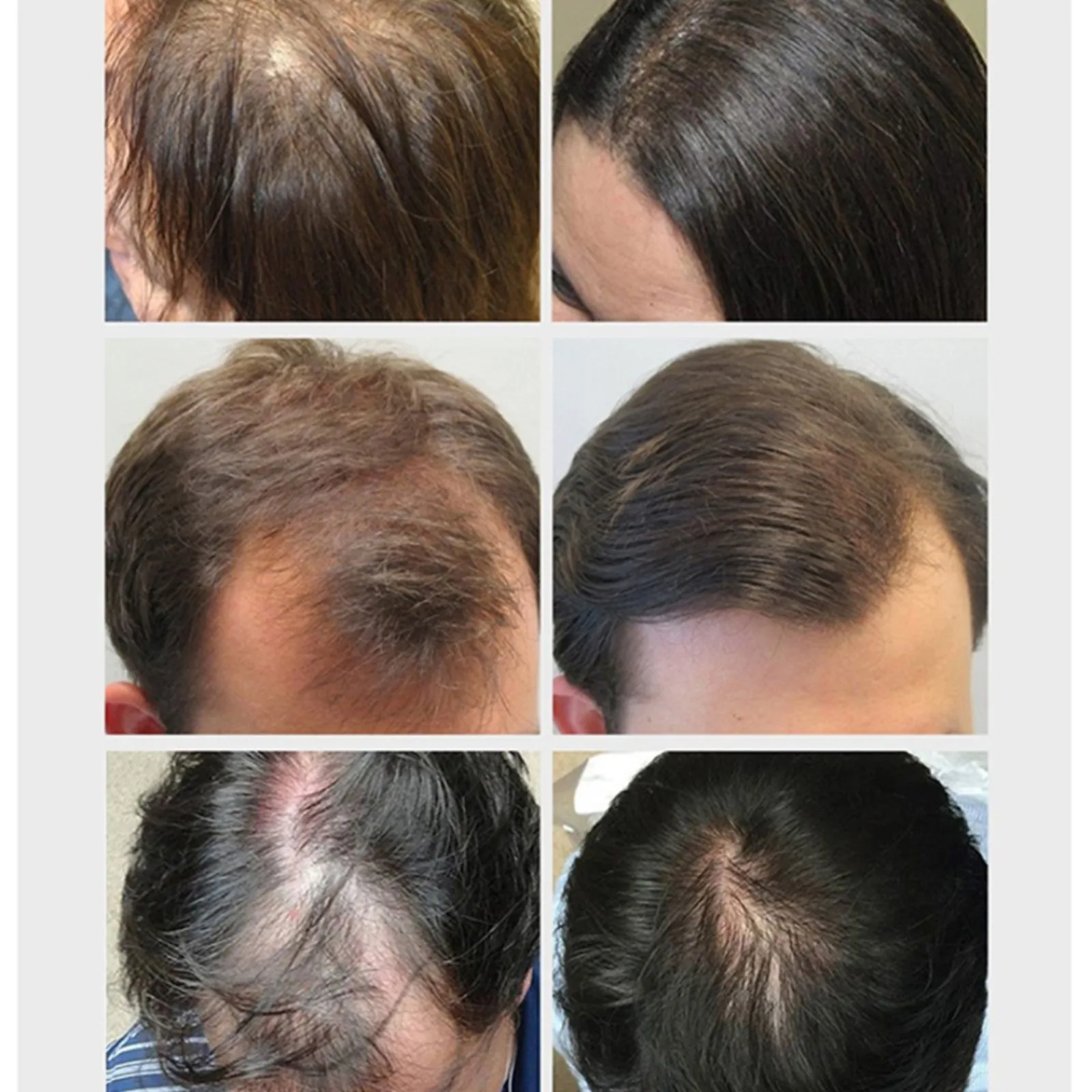 Vichy dercos шампунь от перхоти для чувствительной кожи головы. средство от себорейного дерматита. Vichy dercos для чувствительной кожи. шампунь против себореи кожи головы кето плюс. эффективные средства от себореи сухой перхоти.