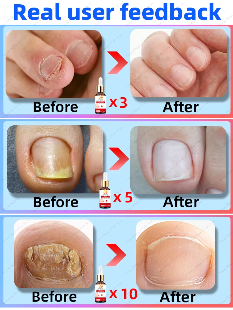 Рисунок 4 - Грибковый ноготь