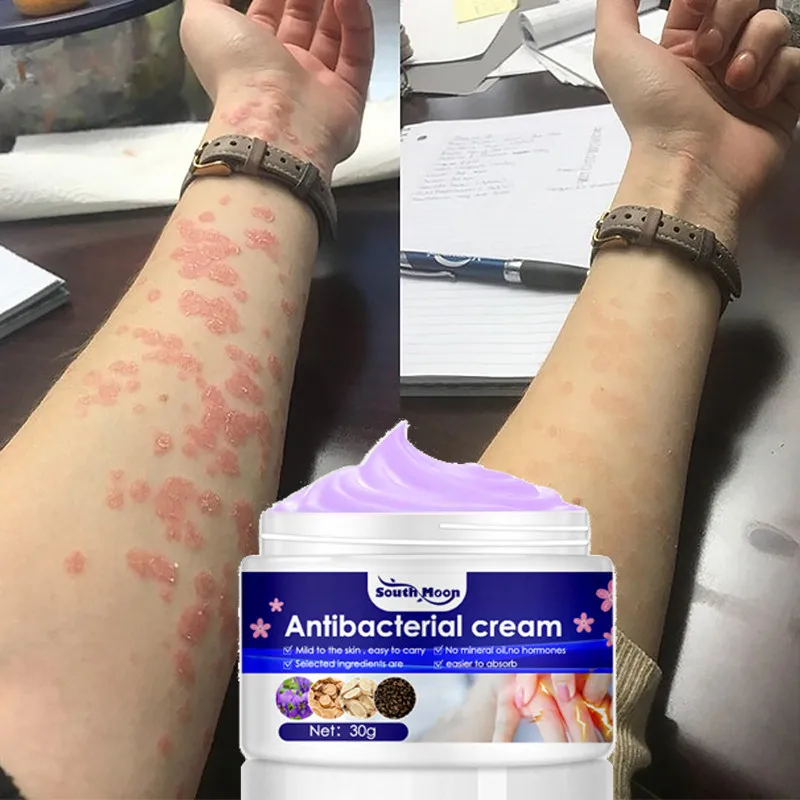 Herbal Psoriasis Cream Dermatitis Eczema Treat Ointment Antibacterial Athlete's Foot Gel Mosquito Bites Allergies Anti-Itch 30g