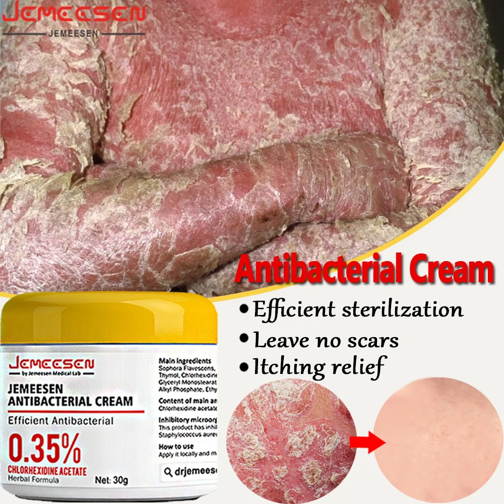 

Увлажняющий крем для всего тела от псориаза, натуральный Восстанавливающий эффективный Антибактериальный Отшелушивающий зуд для кожи, уход за грубой кожей