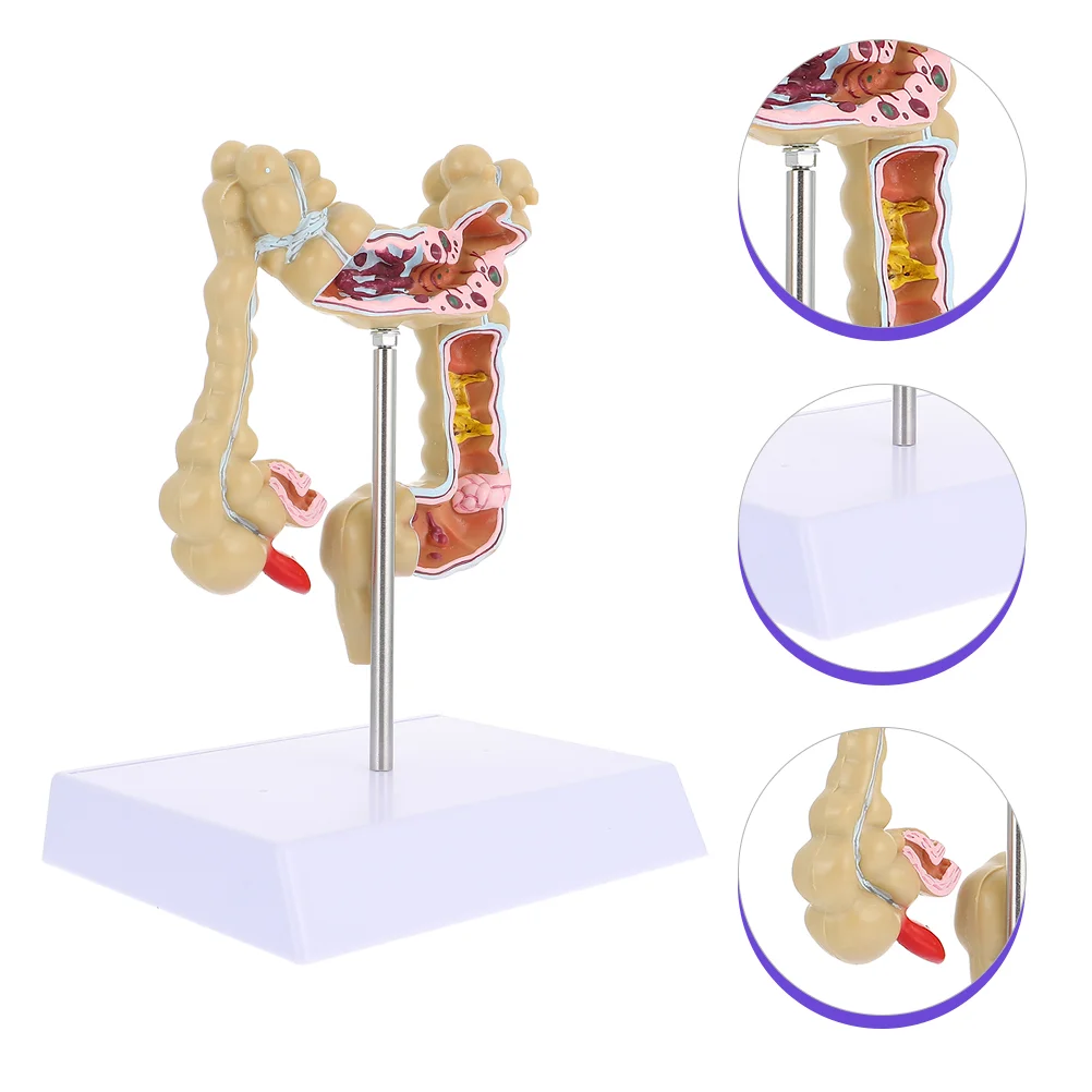 

Human Pathology Large Intestine Model Colon Pathological Teaching Model