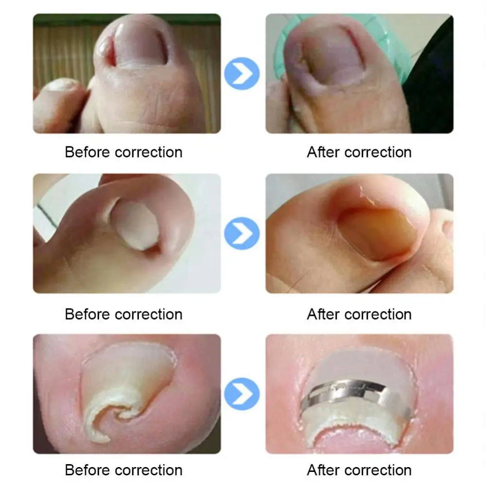 

Toenail Straightening Correctors Foot Health Straightening Clip Brace Safe Innovative Ingrown Toenail Pain Improved Patch Tool
