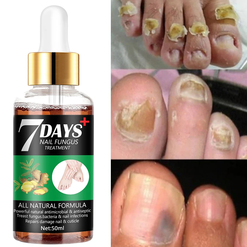 

Extra Strong Toenail Fungus Treatment for Toenails or Fingernails, Nail Repair Solution, for Damaged and Discolored Nails
