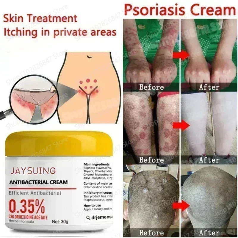 Hot sales Ointment From Psoriasis Work Perfect For Skin Problems Cream Antipruritic Medical Beauty-Health Plaster