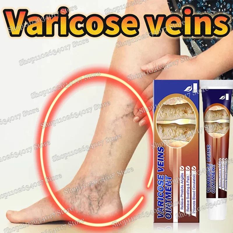 Крем для удаления варикозного расширения вен мазь ухода за телом крем лечения