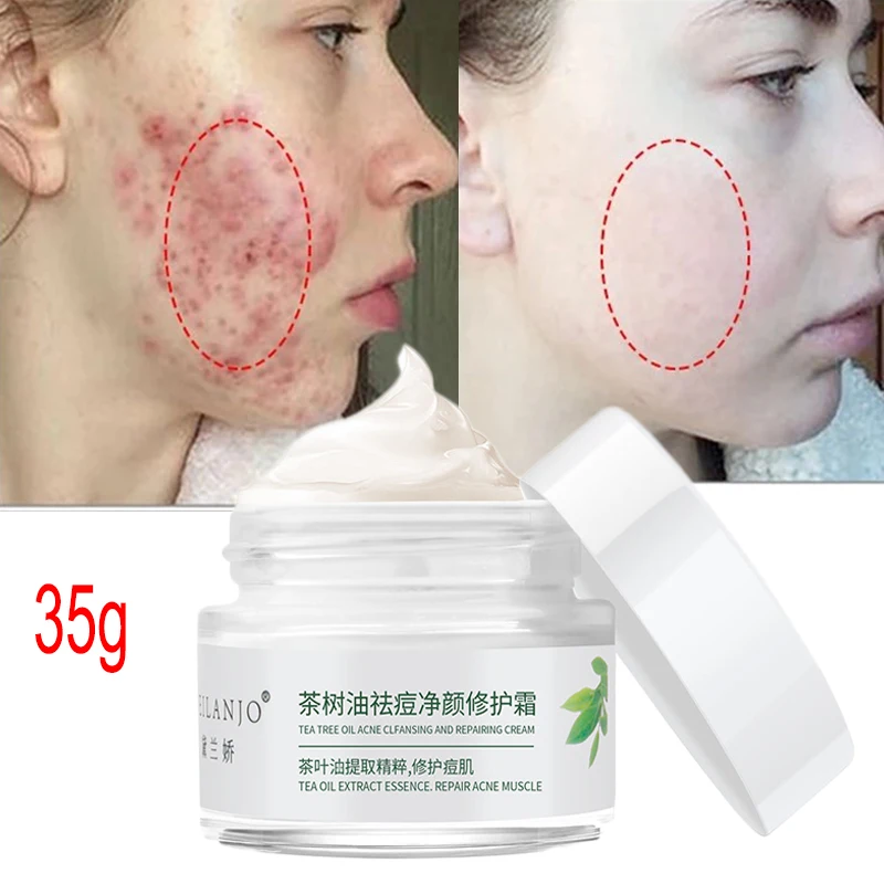 

35g Tea Tree Oil Acne Removal Cream Herbal Anti Acne Fade Spots Oil Control Skin Care Whitening Moisturizing Anti Aging Face Gel
