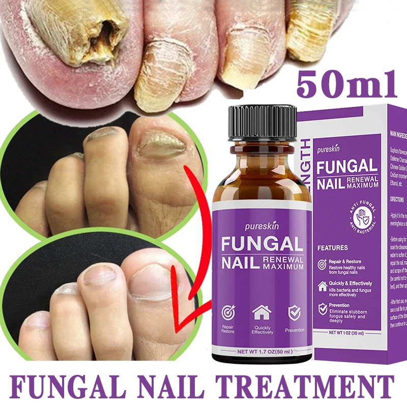 

Nail repair Fungal Nail Treatment Serum Foot Repair Essence Care Whitening Toe Nail Fungus Removal Gel Anti Infection 20ml