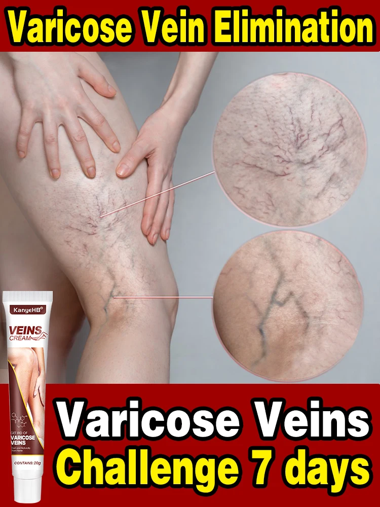 

Effective varicose relief cream to eliminate spider leg Vasculitis phlebitis and relieve pain herbal ointmentl Ointment