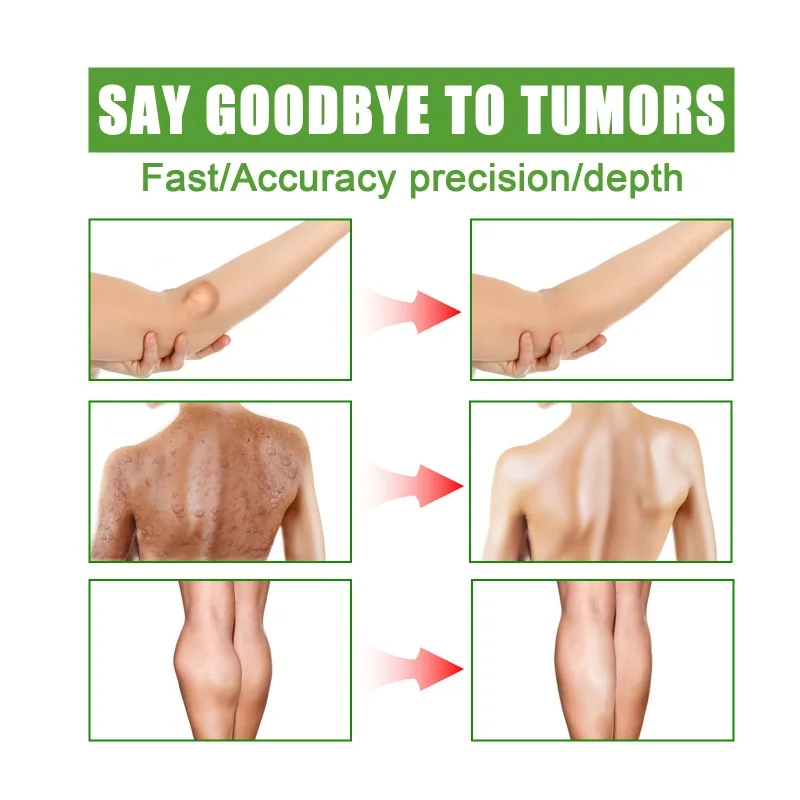 Lipoma крем для удаления жира в кусках нодулярная детоксикация средство лечения