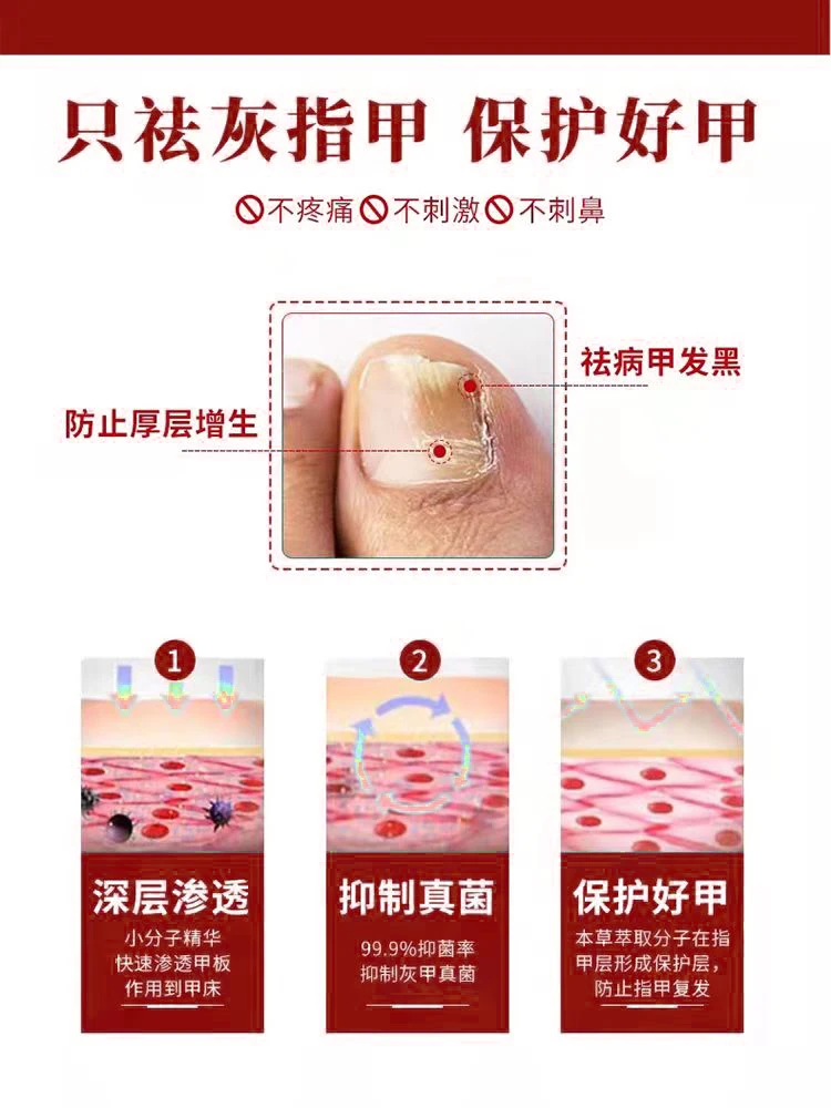 [Watsons Hot Sale] It Is Invalid to Remove 99% Gray Potassium Fungus by Dropping a Drop of Antibacterial and Not Removing Nail!!