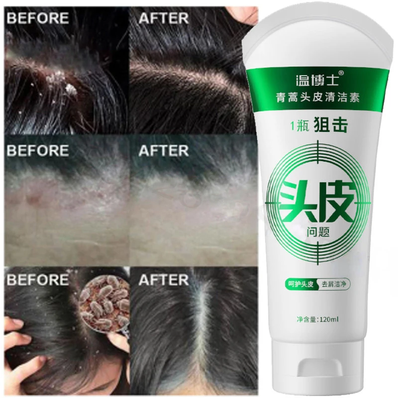 

Artemisia Annua очищающий кожу головы антипругический шампунь для восстановления и устранения перхоти и пушистых волос